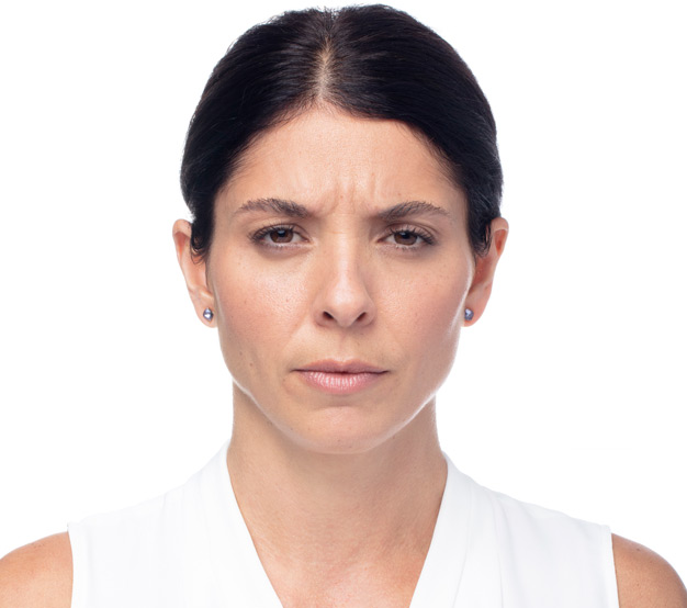 Dysport-Before-Image