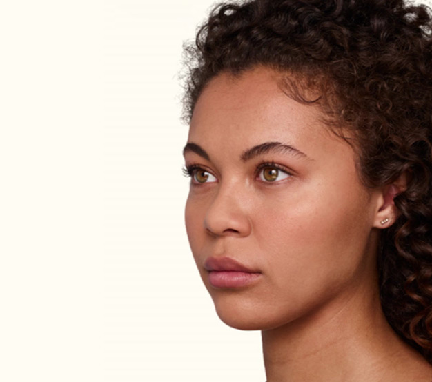 Juvederm-Ultra-Ultra-Plus-After