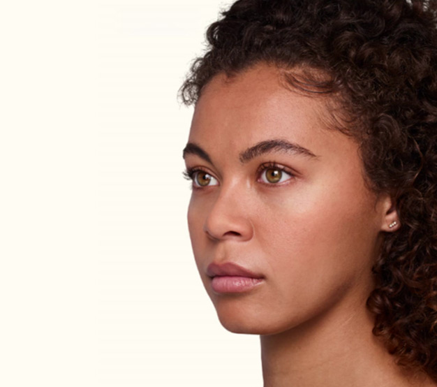 Juvederm-Ultra-Ultra-Plus-Before