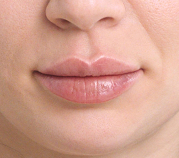 Restylane-Kysse-After