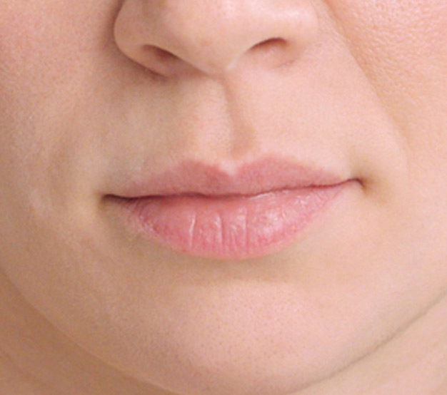 Restylane-Kysse-Before