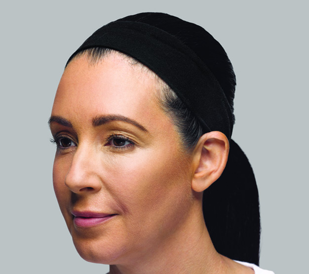 Restylane-Lyft-After