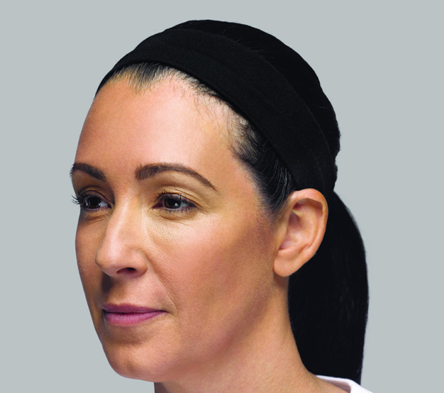 Restylane-Lyft-Before